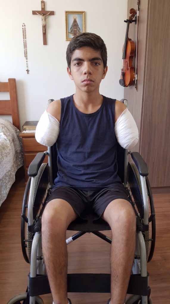 Marcelo, após uma infecção grave que resultou na perda de seus dois braços